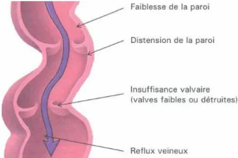 Figure 14 : Formation d'une varice. (21) 