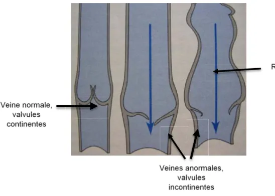 Figure 15 : Mécanisme de reflux par incontinence valvulaire (22) 