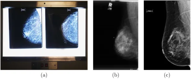 Figure 2.4: Type of mammographic image formats. (a) two mammographic films hanged on a ligth-box for reading purpose, (b) digitized version of a screen-film mammogram, (c) digital mammogram