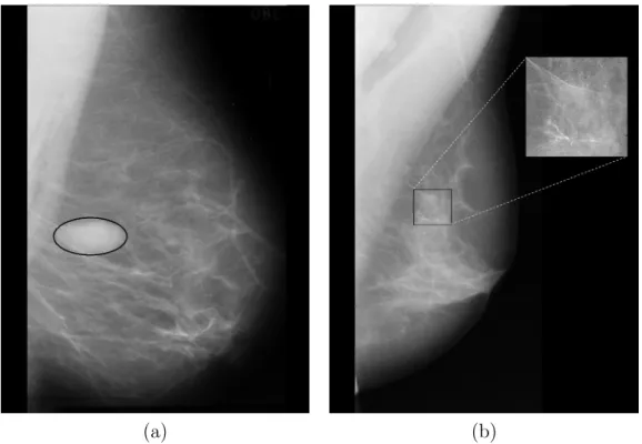 Figure 2.7: Example of breast cancer signs identified in mammograms. (a) manually cir- cir-cumscribed mass with a bold black ellipse, (b) microcalcifications appearing as bright spots in the focused ROI.
