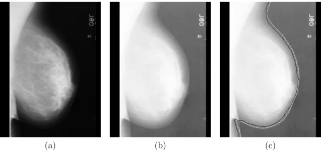 Figure 3.7: Comparison of breast region segmentation using the FCM algorithm and global thresholding method (a) Initial image, (b) logarithmic enhanced image, (c) enhanced image super-impressed with the breast contour extracted using FCM (white) and global