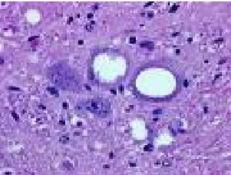 Figure n°4 : Lésions de spongiose neuronale dans le tronc cérébral d’un ovin atteint de  tremblante 