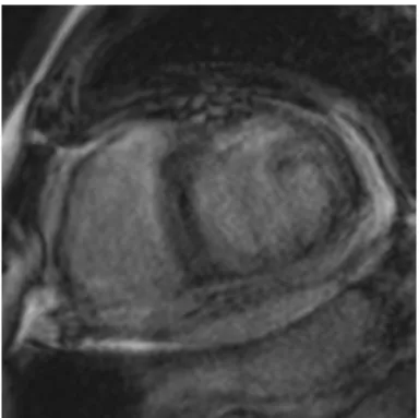 Figure  10  :  Séquence  ciné  bSSFP  en  petit  axe  avec  artefact  de  mistriggering