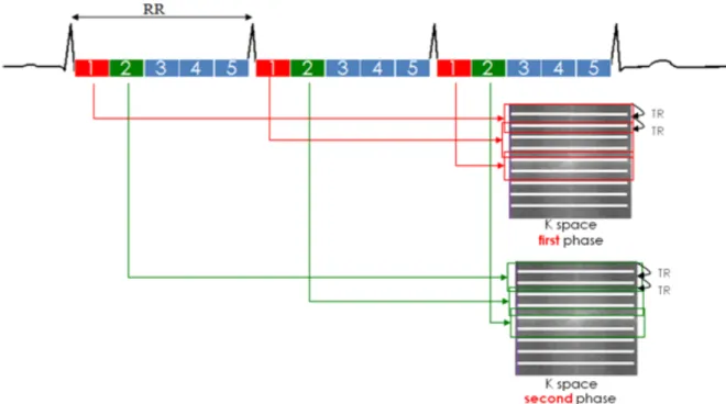 Figure 11 : Principes techniques de l’acquisition de la séquence bSSFP : remplissage  segmenté  du  plan  de  Fourier  (k  space)  correspondant  à  chaque  phase  du  cycle  cardiaque  sur  plusieurs  espaces  R-R