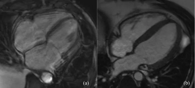 Figure 13 : Séquence bSSFP coupe 4 cavités artefactée (a) et de bonne qualité (b). 