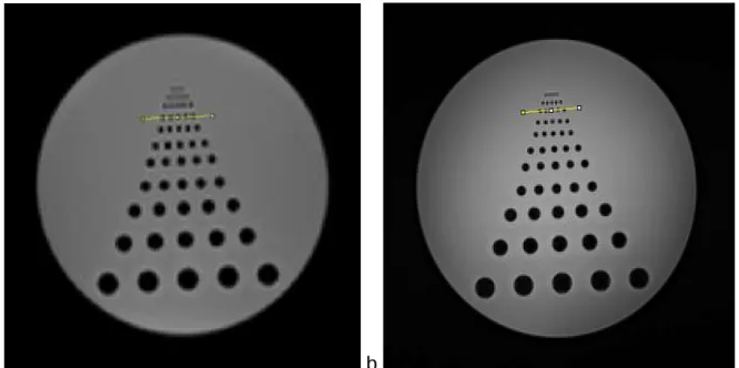 Figure 7: Spatial resolution determined with Phantom Study for VIBE (a) and StarVIBE  (b)