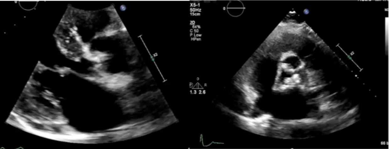 Figure 11 : Échocardiographie d’une sténose aortique en incidence para-sternale grand axe (à gauche)  et court axe (à droite)