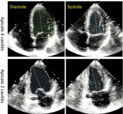 Figure 18 : Estimation de la fraction d’éjection ventriculaire gauche (FEVG) en échocardiographie par  la méthode de Simpson