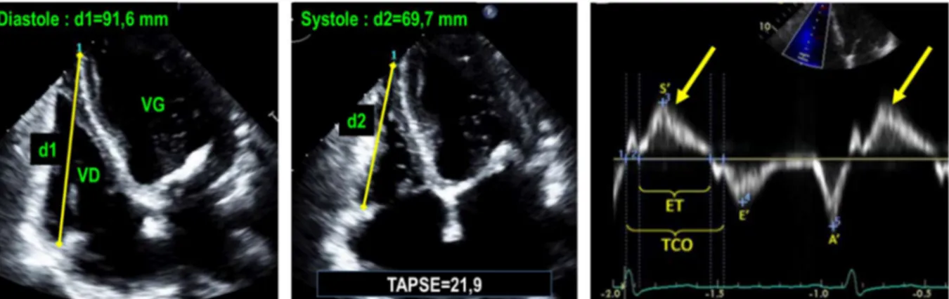 Figure 20 : Les deux images de droite montrent une échocardiographie en incidence apicale 4 cavités  (modifiée pour une focalisation sur le VD) respectivement en diastole (à gauche) et en systole (image  du milieu)