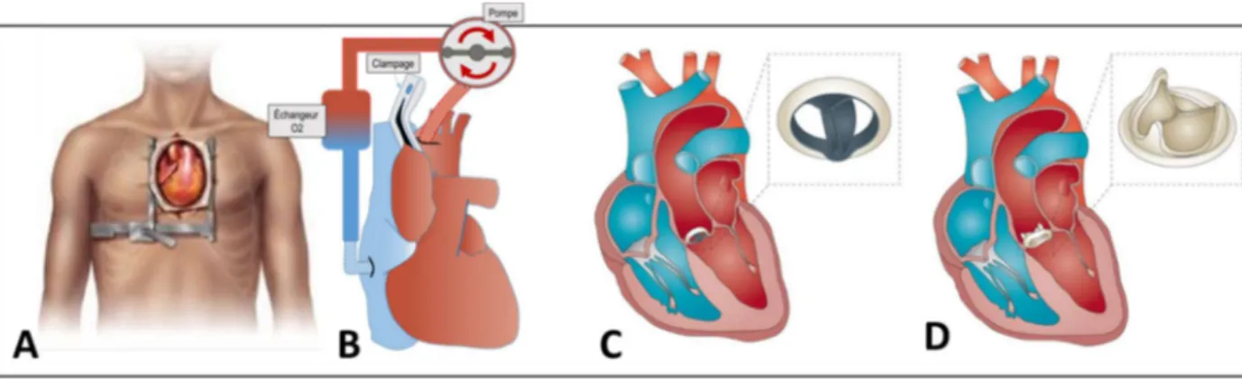 Figure 21 : Le remplacement valvulaire aortique chirurgical est une intervention à cœur ouvert  nécessitant une sternotomie (A) et la mise en place d’une circulation extracorporelle (B)