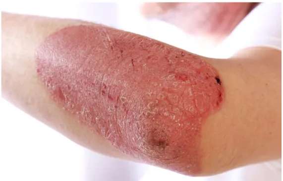 Figure 10. Psoriasis en plaque (20) 
