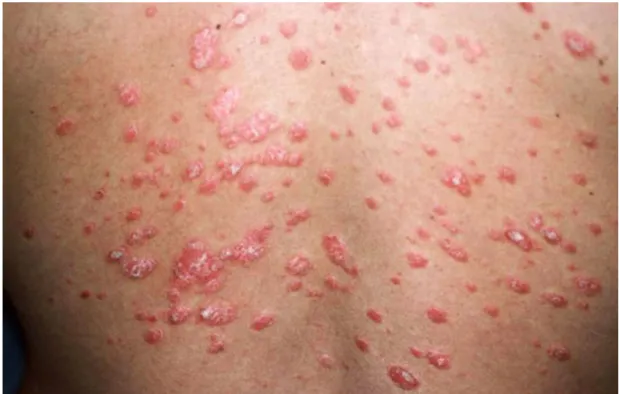 Figure 11. Psoriasis en goutte (22) 