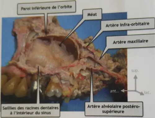 Figure 7 - Coupe anatomique de la paroi supérieure et médiale du sinus maxillaire d’après Gouët et al