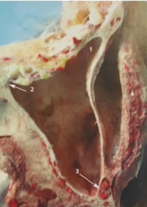 Figure 13 - Coupe anatomique dans le plan axial montrant un prolongement antérieur et zygomatique du sinus maxillaire d’après
