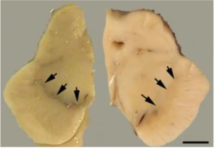 Figure 2 : coupe horizontale de mésencéphale – à gauche, pigmentation normale  de la substance noire, à droite dépigmentation d’une partie de la substance noire 
