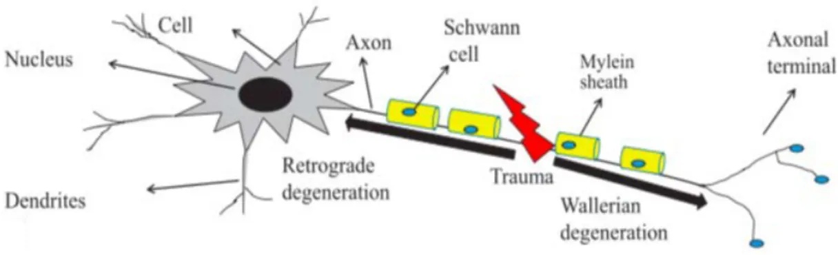 Figure 9 : Schéma d'une lésion nerveuse causant une dégénérescence rétrograde et wallérienne (22) 