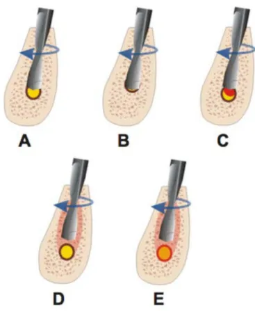 Figure 12 : Schéma des possibles lésions nerveuses lors du forage (33) 
