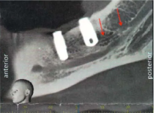 Figure 13 : Image d’un CBCT mettant en évidence le canal alvéolaire mandibulaire et le canal accessoire                            (sous les deux flèches rouges) (32) 