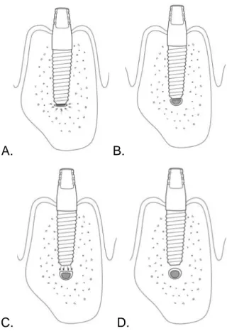 Figure 14 : Schéma présentant les différents types de lésions nerveuses liées au positionnement de l’implant (31) 