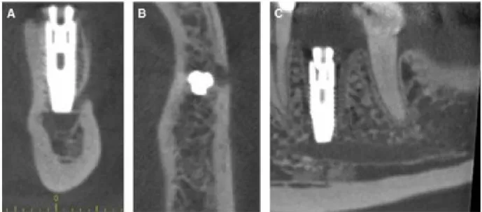 Figure 15 : Images d'un CBCT mettant en évidence un implant dans le nerf alvéolaire inférieur (40) 