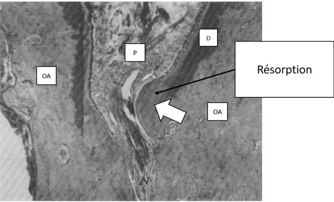 Figure 15 : Résorption dans la région apicale OA=os alvéolaire, P=tissu pulpaire, D= dentine (31) 