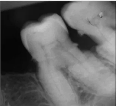 Figure 16 : Hypercémentose des racines mésiales et distales d'une deuxième molaire mandibulaire chez un  patient atteint d'acromégalie(40) 