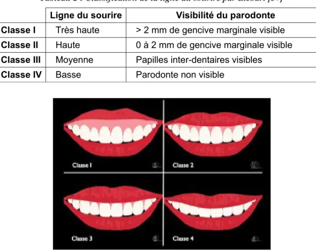 Tableau 2 : Classification de la ligne du sourire par Liébart [37]