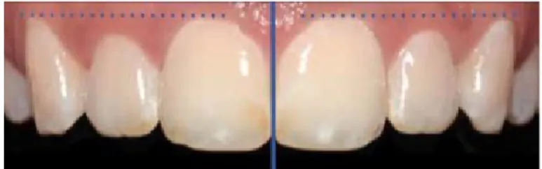 Figure 26 : Niveau gingival de classe I par Rufenacht [21]