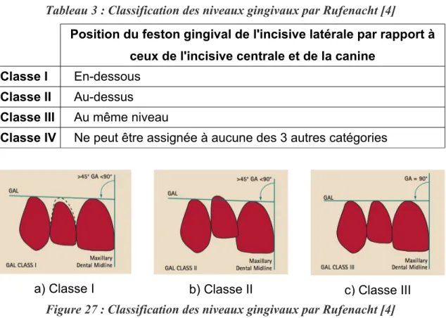 Tableau 3 : Classification des niveaux gingivaux par Rufenacht [4]