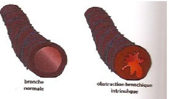 Figure 1: Comparaison entre une bronche 