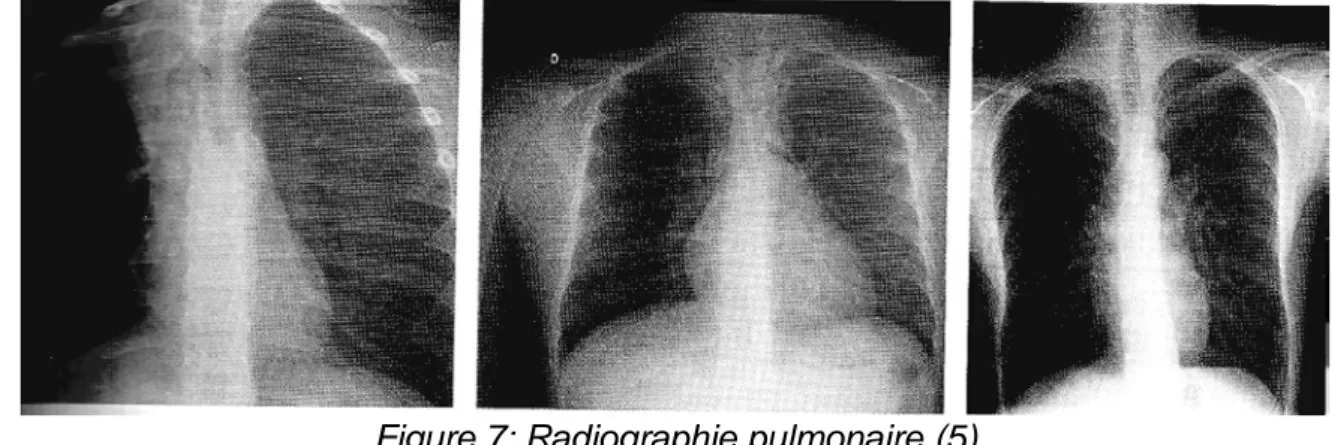 Figure 7: Radiographie pulmonaire (5) 