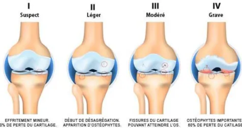 Figure 5. Différents stades (I à IV) de dégénérescence arthrosique du genou (d’après [5]) 