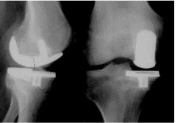 Figure 8. Radiographie d’une prothèse de genou unicompartimentale interne (d’après [7]) 