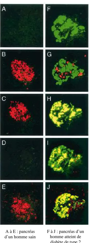 Figure  5 : Mise en évidence et aspect histologique des dépôts amyloïdes et de ses  composants dans les cellules β pancréatiques d’un individu atteint de diabète de 