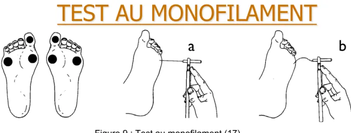 Figure 9 : Test au monofilament (17) 
