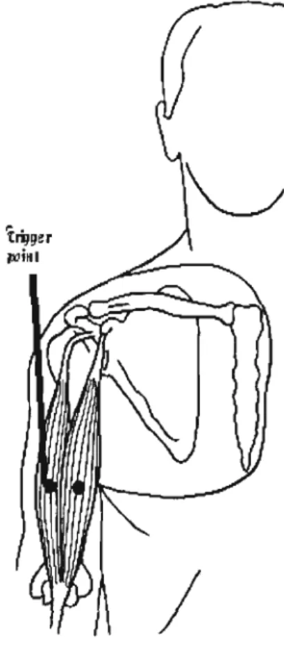 Figure 6:  Long head of the biceps trigger point location 