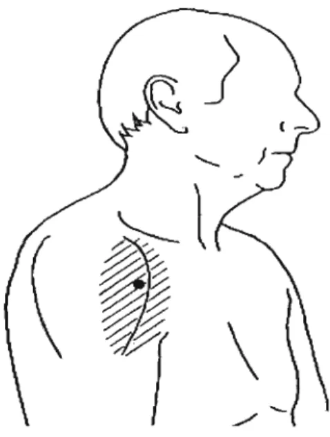Figure 7:  The anterior fibers on the deltoid trigger point location 
