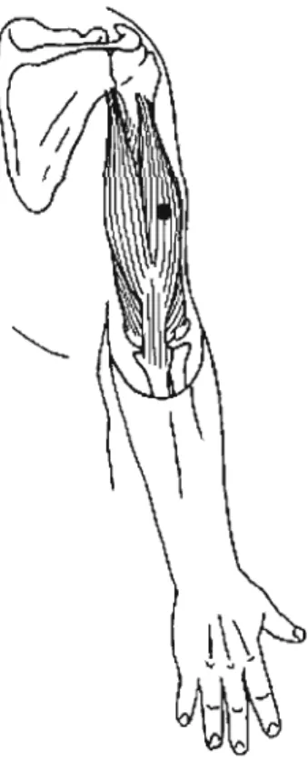 Figure 8:  The lateral head of the triceps trigger point location 