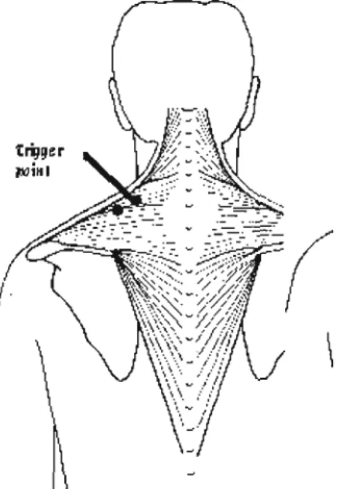Figure 12: The trapezius trigger point location 