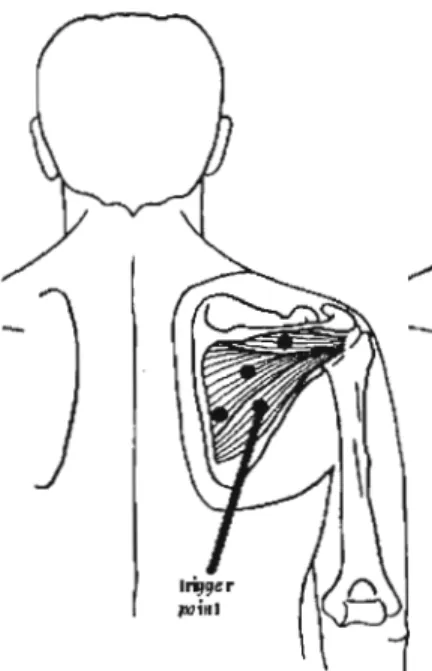 Figure 13:  The infraspinatus trigger point location 