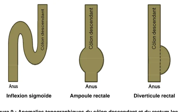 Figure 9 : Anomalies topographiques du côlon descendant et du rectum lors de  hernie périnéale