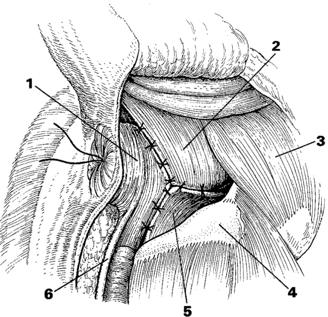 Figure 14 : Schéma montrant une vue peropératoire (vue caudo-latérale) d’une  myoplastie par transposition du muscle obturateur interne (d’après SLATTER  D., 2003 [8])