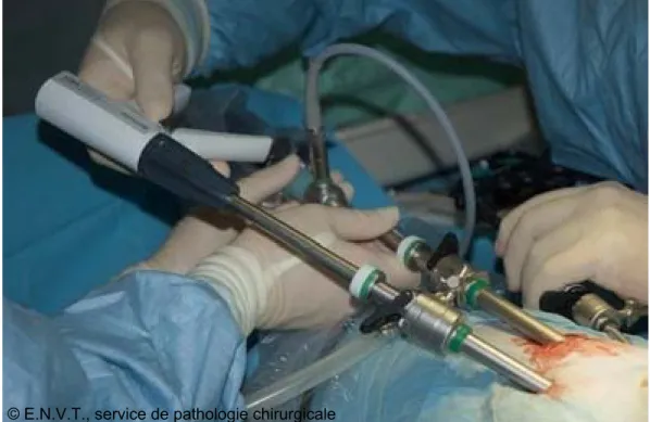 Figure 17 A  : Photographie peropératoire montrant la disposition des canules  laparoscopiques
