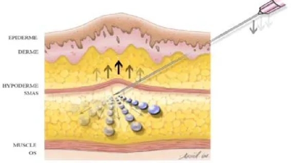 Figure 20 : Technique Vacuum (117)) 