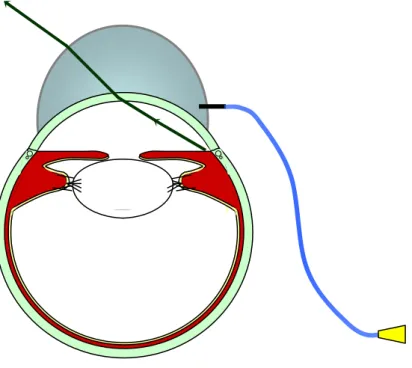 Figure 4 : Principe de la lentille de BARKAN 