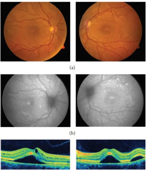 Figure 22 Imagerie multimodale de la première description clinique de la MEKAR (32)  Photos couleur : DSR   multifocaux bilatéraux Autofluorescence  augmentée  OCT : DSR et présence de logettes 