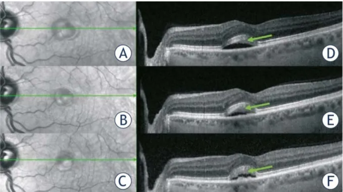Figure 26  Imagerie d’un DSR fovéolaire (42) A-C Images en infrarouge D-F OCT montrant  des fluctuations du décollement séreux rétinien avec des élongations de la zone 
