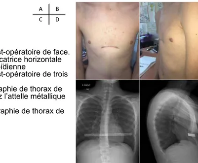 Figure 2: sternochondroplastie selon la technique de A. Wurtz.