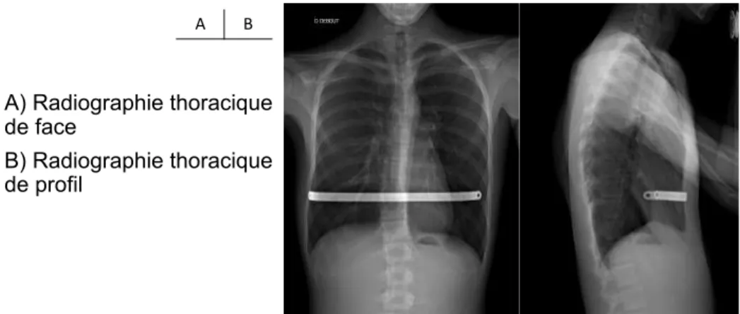 Figure 8: radiographies post-opératoires de face et de profil  post-intervention selon D.Nuss avec fixation de la barre par  point transcostal résorbable.