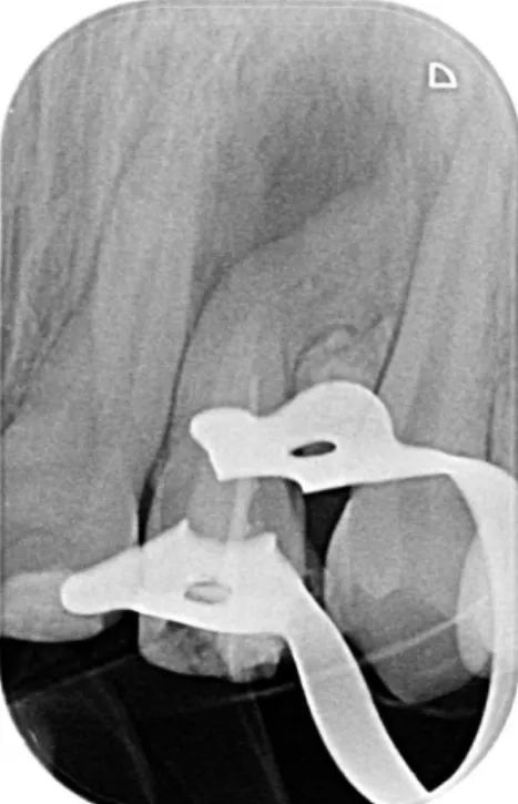 Figure 20 : Chirurgie péri-apicale. a) Levée du lambeau. b) Perforation corticale. c)  Odontome